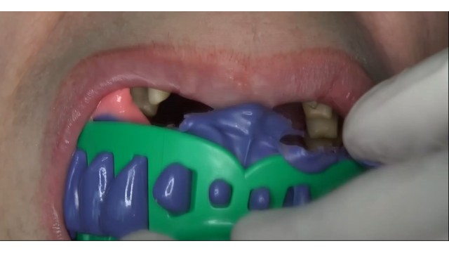 Polieter Ölçü Maddesi Klinik Kullanım İpuçları