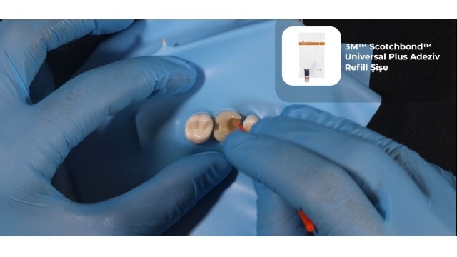 Duvar Kaybı Olan Posterior Dişlerde Silikon İndex Tekniği