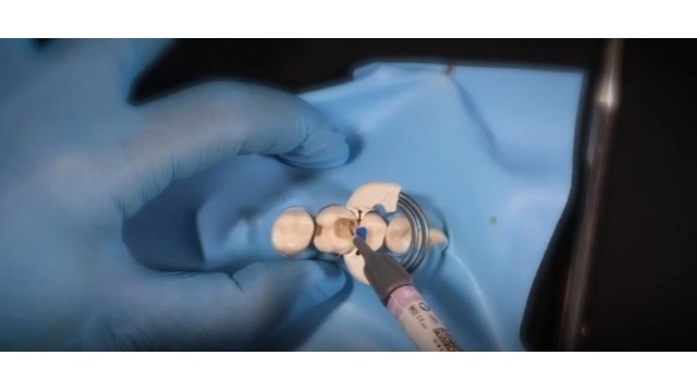 Posterior Arayüz Kavitelerde Bioclear Matris Uygulaması